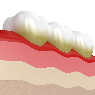 tartar and calculus build up around teeth